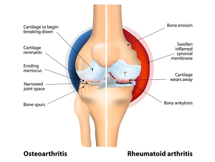 Arthro Akut Arthritis Diagramm